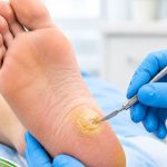 Heel Corn Treatment